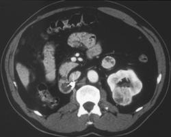 Renal Cell Carcinoma - CTisus CT Scan