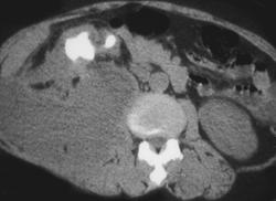 Right Psoas Abscess Due to Xanthogranulomatous Pyelonephritis (XGP) of the Right Kidney - CTisus CT Scan