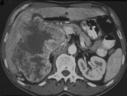 Renal Cell Carcinoma Invades the Inferior Vena Cava (IVC) - CTisus CT Scan