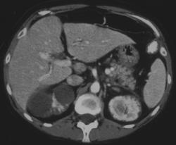 Unusual Form of Polycystic Renal Disease - CTisus CT Scan