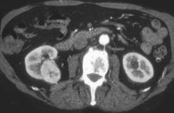 Renal Cell Carcinoma - CTisus CT Scan