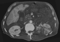 Acute Pyelonephritis - CTisus CT Scan