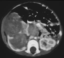 Wilms Tumor - CTisus CT Scan