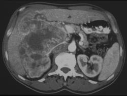 Renal Cell Carcinoma - CTisus CT Scan