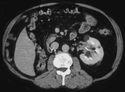 Transitional Cell Carcinoma - CTisus CT Scan