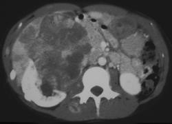 Renal Cell Carcinoma With Muscle Metastases - CTisus CT Scan