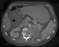 Recurrent Renal Cell Carcinoma Invades the Spine - CTisus CT Scan