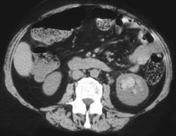 Renal Hemorrhage - CTisus CT Scan