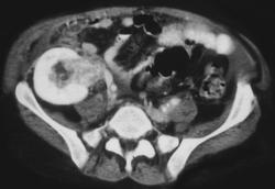 Kaposi Sarcoma in A Transplant - CTisus CT Scan