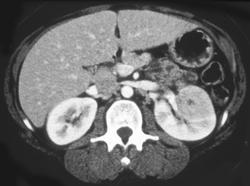 Acute Pyelonephritis - CTisus CT Scan