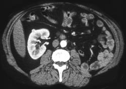 Multifocal Renal Cell Carcinoma - CTisus CT Scan