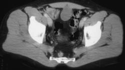 Urachal Carcinoma - CTisus CT Scan