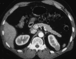 Renal Cell Carcinoma - CTisus CT Scan