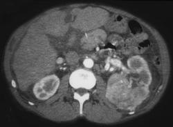 Renal Cell Carcinoma - CTisus CT Scan