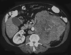 Renal Lymphoma - CTisus CT Scan