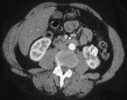 Calcified Hematoma - CTisus CT Scan