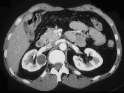 Renal Cyst - CTisus CT Scan