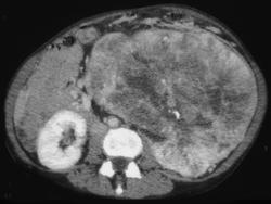 Renal Cell Carcinoma - CTisus CT Scan