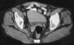 Inverted Fluid Level Bladder in A Diabetic With Glycosuria - CTisus CT Scan