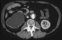 Transitional Cell Carcinoma of the Distal Right Ureter - CTisus CT Scan