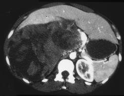 Renal Cell Carcinoma - CTisus CT Scan