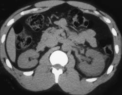 Obstructing Left Distal Calculus in Ureter - CTisus CT Scan