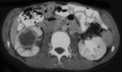 Acute Pyelonephritis With Abscess Right Kidney - CTisus CT Scan