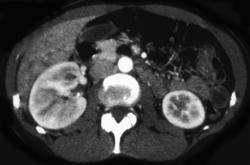 Acute Pyelonephritis - CTisus CT Scan