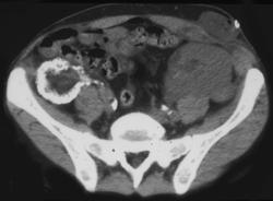 Calcified Failed Right Renal Transplant - CTisus CT Scan