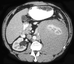 Lymphoma - CTisus CT Scan