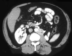 Recurrent Renal Cell Carcinoma in Paraaortic Left Lymph Nodes - CTisus CT Scan