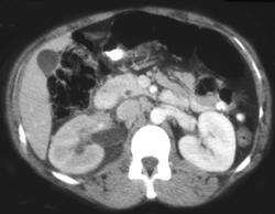 Obstructing Distal Right Ureteral Calcification - CTisus CT Scan