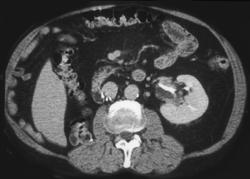 Transitional Cell Carcinoma - CTisus CT Scan