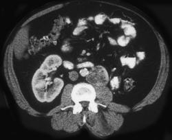 Recurrent Renal Cell Carcinoma in Lymph Nodes Near Nephrectomy Bed - CTisus CT Scan