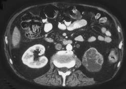 Left Renal Transitional Cell Carcinoma- Note Neobladder - CTisus CT Scan