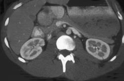 Subtle Renal Laceration - CTisus CT Scan