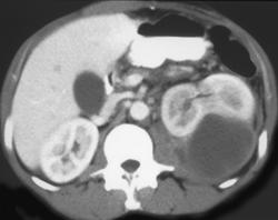 Pseudocyst in Pararenal Space - CTisus CT Scan