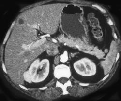 Renal Cell Carcinoma (subtle on Right Kidney) - CTisus CT Scan