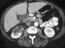 Renal Infarct - CTisus CT Scan