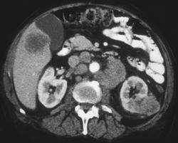 Renal Cell Carcinoma With Nodes and Liver Metastases - CTisus CT Scan