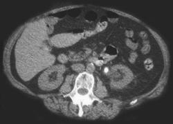 Obstructing Stone in Proximal Left Ureter - CTisus CT Scan