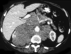 Renal Lymphoma - CTisus CT Scan