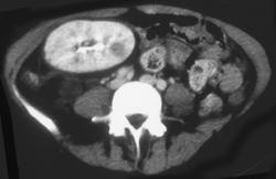 Acute Pyelonephritis in A Transplant - CTisus CT Scan