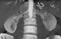 Normal Renal Arteries - CTisus CT Scan