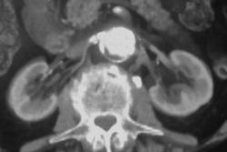 Right Renal Artery Stenosis - CTisus CT Scan