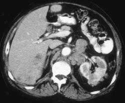 Renal Cell Carcinoma With Liver Metastases - CTisus CT Scan