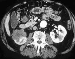 Renal Cell Carcinoma - CTisus CT Scan