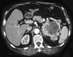 Renal Cell Carcinoma - CTisus CT Scan