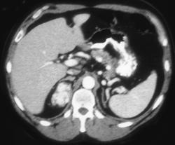 Metastases to the Right Adrenal Gland Due to Renal Cell Carcinoma - CTisus CT Scan