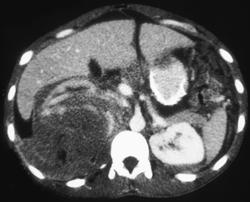 Renal Cell Carcinoma With Bleed - CTisus CT Scan